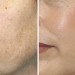 BEAUTIFUL SKIN FOR THE NEW YEAR – Microdermabrasion Special BEAUTIFUL SKIN FOR THE NEW YEAR – Microdermabrasion Special