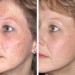 REJUVENATE YOUR SKIN WITH A LIGHT FACIAL PEEL REJUVENATE YOUR SKIN WITH A LIGHT FACIAL PEEL
